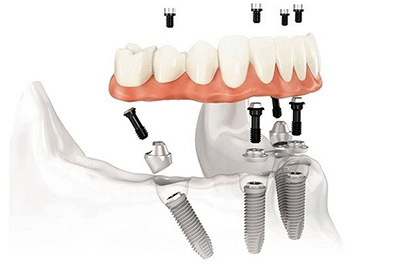 Сколько стоит сделать все зубы на 4 имплантах? Стоит ли вкладывать деньги?